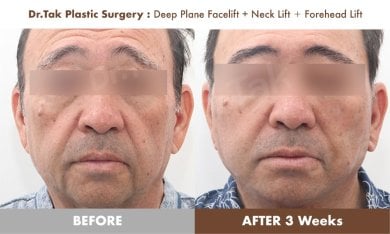 before-after photo tightening-of-facial-skin-facelift