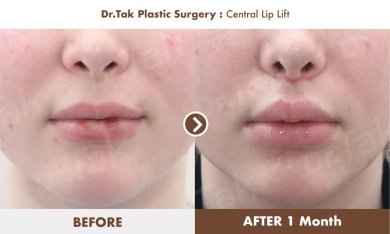 Efekty przed i po centralnym liftingu ust w Dr. Tak Plastic Surgery, poprawiony kontur ust