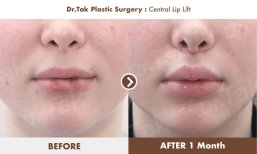 Efekty przed i po centralnym liftingu ust w Dr. Tak Plastic Surgery, poprawiony kontur ust