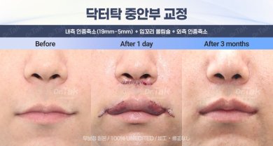 Efekty przed i po liftingu ust i skróceniu rynienki w klinice Dr. Tak Plastic Surgery