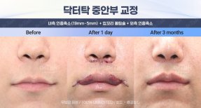 Efekty przed i po liftingu ust i skróceniu rynienki w klinice Dr. Tak Plastic Surgery