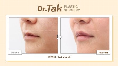 Efekty przed i po centralnym liftingu ust w Dr. Tak Plastic Surgery, poprawiony kontur
