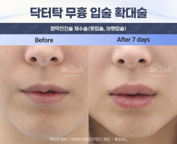 Efekt powiększania ust w Dr. Tak Plastic Surgery, pełniejsze usta po 7 dniach