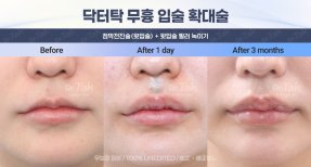 Efekty powiększania ust przed i po w Dr. Tak Plastic Surgery, pełniejsze usta po 3 miesiącach