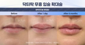 Efekty powiększania ust przed i po w Dr. Tak Plastic Surgery, pełniejsze usta po 6 miesiącach