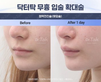 Przed i po powiększaniu ust w Dr. Tak Plastic Surgery, pełniejsze usta po 1 dniu