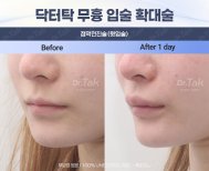 Przed i po powiększaniu ust w Dr. Tak Plastic Surgery, pełniejsze usta po 1 dniu