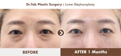 Efekty dolnej blefaroplastyki przed i po w Dr. Tak Plastic Surgery, mniej worków pod oczami