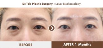Efekty dolnej blefaroplastyki przed i po w Dr. Tak Plastic Surgery, mniej worków pod oczami