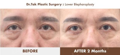 Efekty dolnej blefaroplastyki przed i po w Dr. Tak Plastic Surgery, mniej worków pod oczami