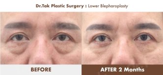 Efekty dolnej blefaroplastyki przed i po w Dr. Tak Plastic Surgery, mniej worków pod oczami