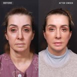 Efekty mini liftingu twarzy przed i po w VG Plastic Surgery, widoczne odmłodzenie