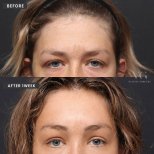 Efekty mini liftingu twarzy przed i po w VG Plastic Surgery – odmłodzenie twarzy