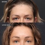 Before and after upper eyelid surgery results at VG Plastic Surgery, 1 week post-procedure