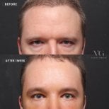Before and after upper eyelid surgery results at VG Plastic Surgery, improved eye appearance