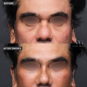 Vorher-nachher-Ergebnis Oberlidstraffung bei VG Plastic Surgery, sichtbare Augenverbesserung