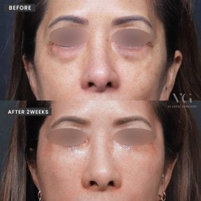 Vorher-nachher-Ergebnis Oberlidstraffung bei VG Plastic Surgery, verbesserte Augenpartie
