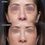 Before and after upper eyelid surgery results at VG Plastic Surgery, improved eye appearance