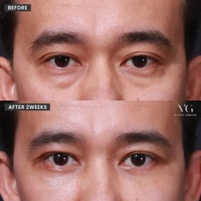Vorher-nachher-Ergebnis Oberlidstraffung bei VG Plastic Surgery, verbesserte Augenpartie