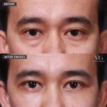 Before and after upper eyelid surgery results at VG Plastic Surgery, improved eye appearance