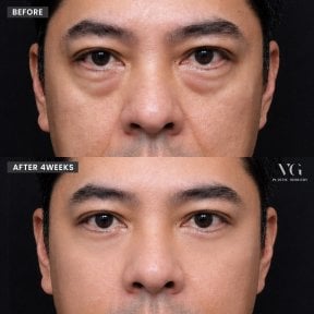 Vorher-nachher-Ergebnis Oberlidstraffung bei VG Plastic Surgery, verbesserte Augenpartie