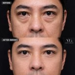 Upper eyelid surgery before and after results at VG Plastic Surgery, improved eye appearance