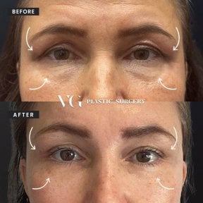 Vorher-nachher-Ergebnis Oberlidstraffung bei VG Plastic Surgery, verjüngte Augenpartie