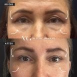 Before and after upper eyelid surgery results at VG Plastic Surgery, rejuvenated eye area