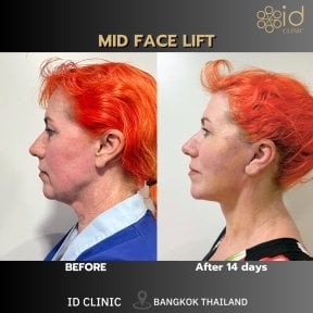 Результаты до и после средней подтяжки лица в ID Clinic Bangkok, видимое омоложение