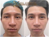 Before and after chin implant results at Asia Cosmetic Hospital, improved chin contour visible