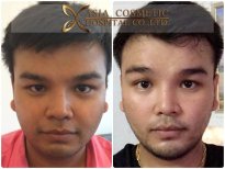 Before and after chin implant results at Asia Cosmetic Hospital, enhanced chin contour visible