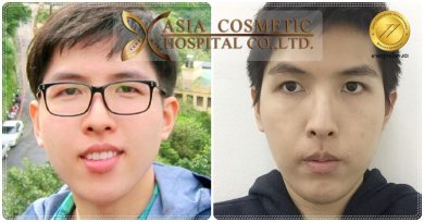 Before and after chin implant results at Asia Cosmetic Hospital, improved chin contour visible
