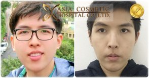 Before and after chin implant results at Asia Cosmetic Hospital, improved chin contour visible