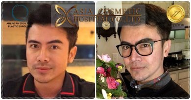 Before and after chin implant results at Asia Cosmetic Hospital, improved chin contour visible
