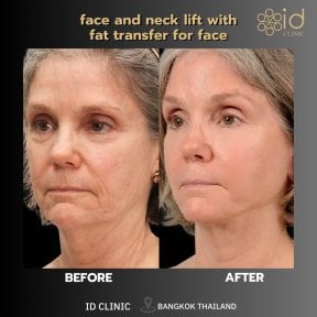 Результат мини-подтяжки лица и шеи с липофилингом в ID Clinic Bangkok, до и после