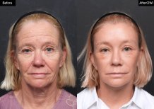 Efekty przed i po deep plane facelift w VG Plastic Surgery, widoczne odmłodzenie twarzy