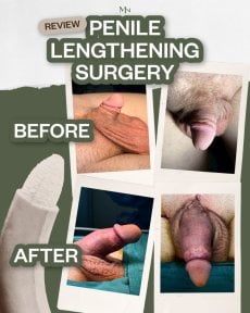 Before and after penis enlargement results at Menness Wellness Clinic, visible length increase