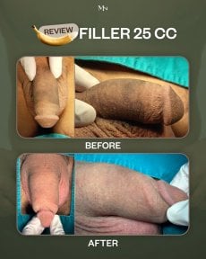Before and after penis enlargement with 25cc filler at Menness Wellness Clinic, visible result