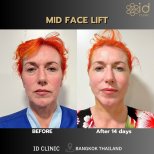 Результаты до и после подтяжки средней зоны лица в ID Clinic Bangkok, омоложение лица