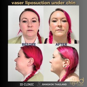 До и после VASER липосакции подбородка в ID Clinic Bangkok, видимый контурный результат