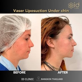 До и после Vaser липосакции подбородка в ID Clinic Bangkok, видимый контурный результат