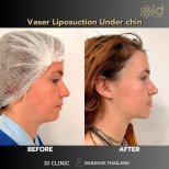 До и после Vaser липосакции подбородка в ID Clinic Bangkok, видимый контурный результат