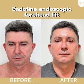 Результаты до и после эндоскопической подтяжки лба Endotine в ID Clinic Bangkok