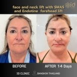 До и после SMAS-лифтинга лица и шеи и подтяжки бровей Endotine в ID Clinic Bangkok