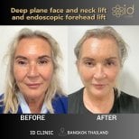Результаты до и после глубокого лифтинга лица, шеи и лба в ID Clinic Bangkok