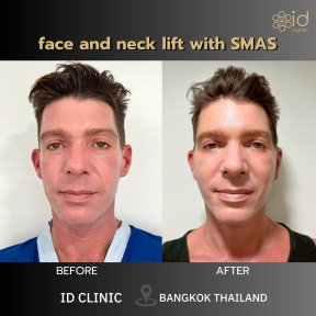 before-after photo podtazka-kozi-lica-fejslift