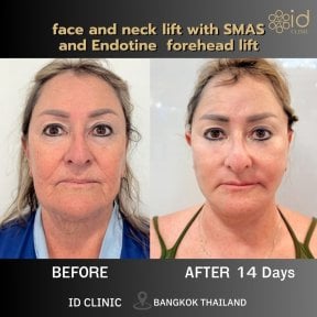before-after photo podtazka-kozi-lica-fejslift