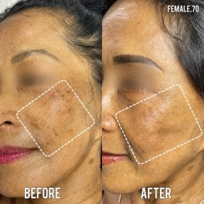 before-after photo stem-cell-rejuvenation-therapy