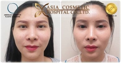 before-after photo plastika-lba-implant
