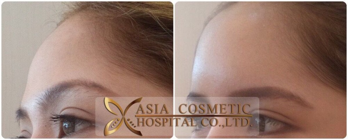 Resultados antes y después de aumento de frente con implante en Asia Cosmetic Hospital, contorno suave